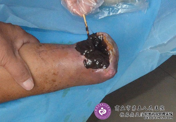 康复案例:{C}{C}{C}{C}<!--HAODF:8:tangniaobing--><a  data-cke-saved-href='//www.haodf.com/jibing/tangniaobing.htm' href='//www.haodf.com/jibing/tangniaobing.htm' style='text-decoration:none;' target='_blank'>糖尿病</a>{C}{C}{C}{C}<!--HAODF:/8:tangniaobing-->人上肢外伤截肢{C}{C}{C}{C}<!--HAODF:8:ganran--><a  data-cke-saved-href='//www.haodf.com/jibing/ganran.htm' href='//www.haodf.com/jibing/ganran.htm' style='text-decoration:none;' target='_blank'>感染</a>{C}{C}{C}{C}<!--HAODF:/8:ganran-->不愈合一例