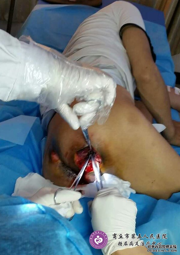 难愈合性创面：腰椎<a  data-cke-saved-href='//www.haodf.com/jibing/guzhe.htm' href='//www.haodf.com/jibing/guzhe.htm' style='text-decoration:none;' target='_blank'>骨折</a>高位截瘫引起的多发褥疮一例