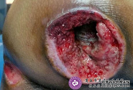 难愈合性创面：腰椎<a  data-cke-saved-href='//www.haodf.com/jibing/guzhe.htm' href='//www.haodf.com/jibing/guzhe.htm' style='text-decoration:none;' target='_blank'>骨折</a>高位截瘫引起的多发褥疮一例