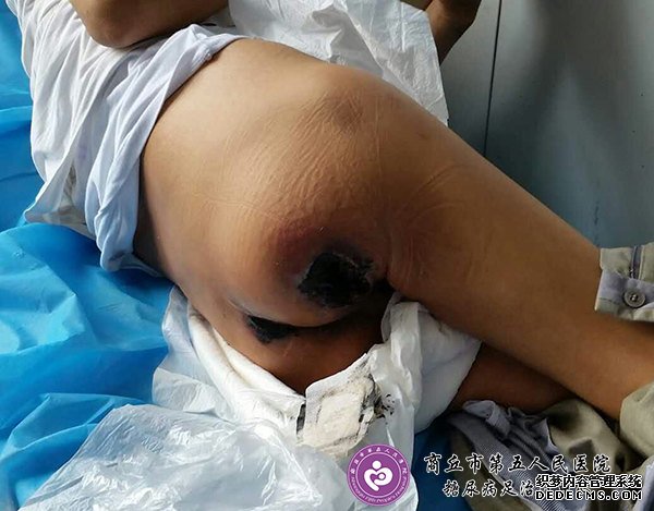 难愈合性创面：腰椎<a  data-cke-saved-href='//www.haodf.com/jibing/guzhe.htm' href='//www.haodf.com/jibing/guzhe.htm' style='text-decoration:none;' target='_blank'>骨折</a>高位截瘫引起的多发褥疮一例