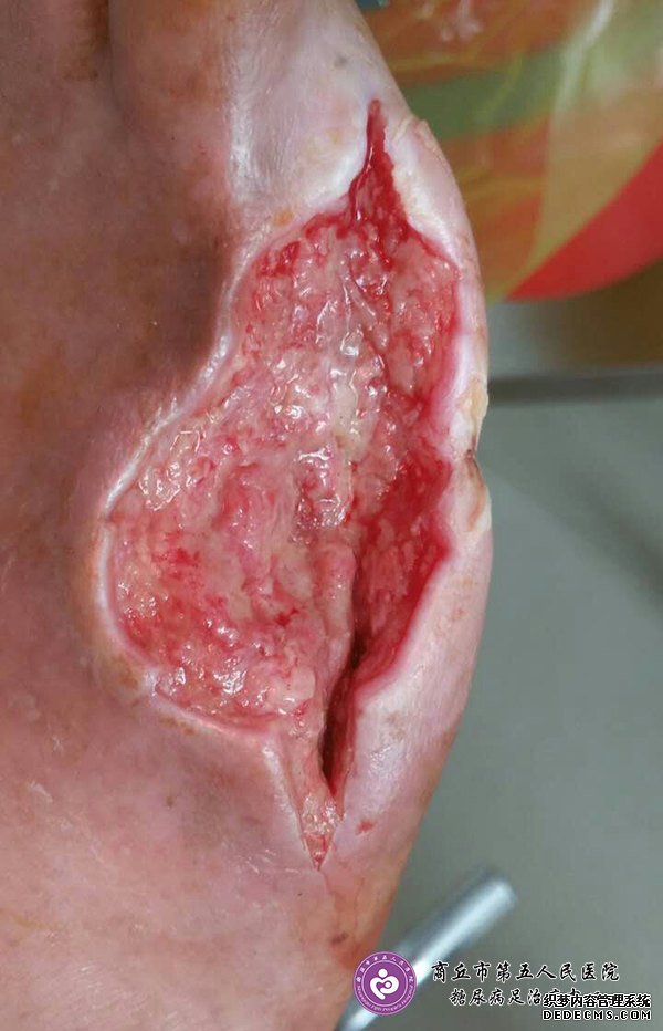 <a  data-cke-saved-href='//www.haodf.com/jibing/tangniaobing.htm' href='//www.haodf.com/jibing/tangniaobing.htm' style='text-decoration:none;' target='_blank'>糖尿病</a>足治疗案例：<a  data-cke-saved-href='//www.haodf.com/jibing/tangniaobing.htm' href='//www.haodf.com/jibing/tangniaobing.htm' style='text-decoration:none;' target='_blank'>糖尿病</a>足截趾不愈合不植皮完全康复一例