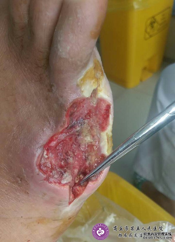 <a  data-cke-saved-href='//www.haodf.com/jibing/tangniaobing.htm' href='//www.haodf.com/jibing/tangniaobing.htm' style='text-decoration:none;' target='_blank'>糖尿病</a>足治疗案例：<a  data-cke-saved-href='//www.haodf.com/jibing/tangniaobing.htm' href='//www.haodf.com/jibing/tangniaobing.htm' style='text-decoration:none;' target='_blank'>糖尿病</a>足截趾不愈合不植皮完全康复一例