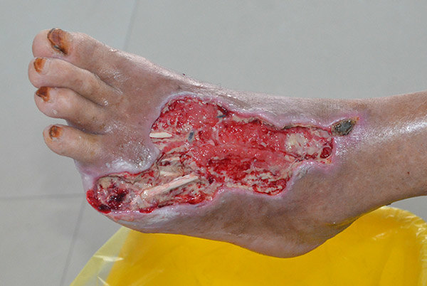 河南信阳{C}{C}{C}{C}<!--HAODF:8:tangniaobing-->{C}{C}{C}{C}<!--HAODF:8:tangniaobing-->{C}{C}{C}{C}<!--HAODF:8:tangniaobing--><a  data-cke-saved-href='//www.haodf.com/jibing/tangniaobing.htm' href='//www.haodf.com/jibing/tangniaobing.htm' style='text-decoration:none;' target='_blank'>糖尿病</a>{C}{C}{C}{C}<!--HAODF:/8:tangniaobing-->{C}{C}{C}{C}<!--HAODF:/8:tangniaobing-->{C}{C}{C}{C}<!--HAODF:/8:tangniaobing-->足病人的保守保肢治疗过程分享