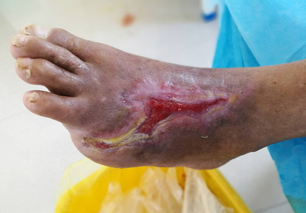 河南信阳{C}{C}{C}{C}<!--HAODF:8:tangniaobing-->{C}{C}{C}{C}<!--HAODF:8:tangniaobing-->{C}{C}{C}{C}<!--HAODF:8:tangniaobing--><a  data-cke-saved-href='//www.haodf.com/jibing/tangniaobing.htm' href='//www.haodf.com/jibing/tangniaobing.htm' style='text-decoration:none;' target='_blank'>糖尿病</a>{C}{C}{C}{C}<!--HAODF:/8:tangniaobing-->{C}{C}{C}{C}<!--HAODF:/8:tangniaobing-->{C}{C}{C}{C}<!--HAODF:/8:tangniaobing-->足病人的保守保肢治疗过程分享