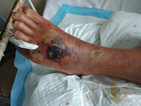 河南信阳{C}{C}{C}{C}<!--HAODF:8:tangniaobing-->{C}{C}{C}{C}<!--HAODF:8:tangniaobing-->{C}{C}{C}{C}<!--HAODF:8:tangniaobing--><a  data-cke-saved-href='//www.haodf.com/jibing/tangniaobing.htm' href='//www.haodf.com/jibing/tangniaobing.htm' style='text-decoration:none;' target='_blank'>糖尿病</a>{C}{C}{C}{C}<!--HAODF:/8:tangniaobing-->{C}{C}{C}{C}<!--HAODF:/8:tangniaobing-->{C}{C}{C}{C}<!--HAODF:/8:tangniaobing-->足病人的保守保肢治疗过程分享