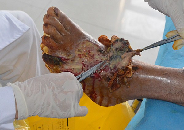 河南信阳{C}{C}{C}{C}<!--HAODF:8:tangniaobing-->{C}{C}{C}{C}<!--HAODF:8:tangniaobing-->{C}{C}{C}{C}<!--HAODF:8:tangniaobing--><a  data-cke-saved-href='//www.haodf.com/jibing/tangniaobing.htm' href='//www.haodf.com/jibing/tangniaobing.htm' style='text-decoration:none;' target='_blank'>糖尿病</a>{C}{C}{C}{C}<!--HAODF:/8:tangniaobing-->{C}{C}{C}{C}<!--HAODF:/8:tangniaobing-->{C}{C}{C}{C}<!--HAODF:/8:tangniaobing-->足病人的保守保肢治疗过程分享