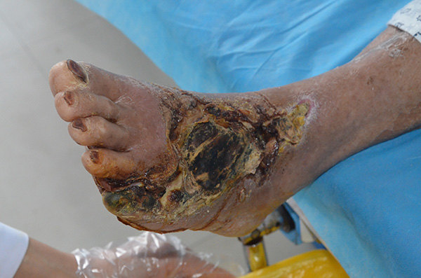 河南信阳{C}{C}{C}{C}<!--HAODF:8:tangniaobing-->{C}{C}{C}{C}<!--HAODF:8:tangniaobing-->{C}{C}{C}{C}<!--HAODF:8:tangniaobing--><a  data-cke-saved-href='//www.haodf.com/jibing/tangniaobing.htm' href='//www.haodf.com/jibing/tangniaobing.htm' style='text-decoration:none;' target='_blank'>糖尿病</a>{C}{C}{C}{C}<!--HAODF:/8:tangniaobing-->{C}{C}{C}{C}<!--HAODF:/8:tangniaobing-->{C}{C}{C}{C}<!--HAODF:/8:tangniaobing-->足病人的保守保肢治疗过程分享