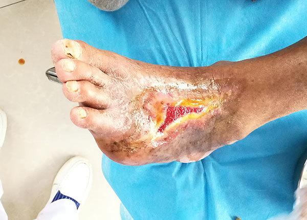 河南信阳{C}{C}{C}{C}<!--HAODF:8:tangniaobing-->{C}{C}{C}{C}<!--HAODF:8:tangniaobing-->{C}{C}{C}{C}<!--HAODF:8:tangniaobing--><a  data-cke-saved-href='//www.haodf.com/jibing/tangniaobing.htm' href='//www.haodf.com/jibing/tangniaobing.htm' style='text-decoration:none;' target='_blank'>糖尿病</a>{C}{C}{C}{C}<!--HAODF:/8:tangniaobing-->{C}{C}{C}{C}<!--HAODF:/8:tangniaobing-->{C}{C}{C}{C}<!--HAODF:/8:tangniaobing-->足病人的保守保肢治疗过程分享