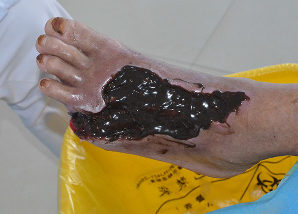 河南信阳{C}{C}{C}{C}<!--HAODF:8:tangniaobing-->{C}{C}{C}{C}<!--HAODF:8:tangniaobing-->{C}{C}{C}{C}<!--HAODF:8:tangniaobing--><a  data-cke-saved-href='//www.haodf.com/jibing/tangniaobing.htm' href='//www.haodf.com/jibing/tangniaobing.htm' style='text-decoration:none;' target='_blank'>糖尿病</a>{C}{C}{C}{C}<!--HAODF:/8:tangniaobing-->{C}{C}{C}{C}<!--HAODF:/8:tangniaobing-->{C}{C}{C}{C}<!--HAODF:/8:tangniaobing-->足病人的保守保肢治疗过程分享